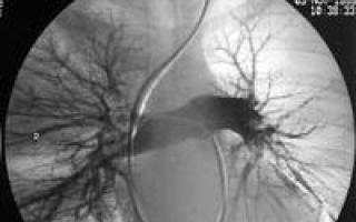 Тромбоэмболия легочной артерии (тэла) - причины, диагностика, лечение Тромбоэмболия сердечная